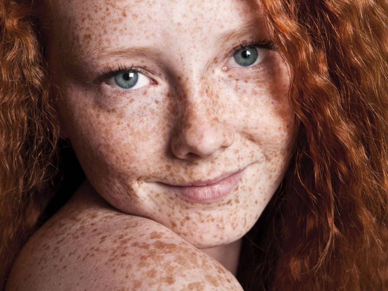 Что такое пигментация кожи и как с ней бороться